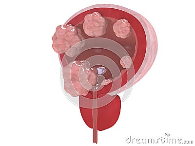 Bladder cancer stages Cartoon Illustration