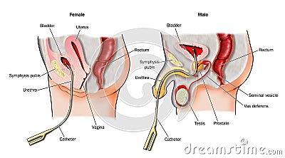 Bladder catheters in-situ Vector Illustration