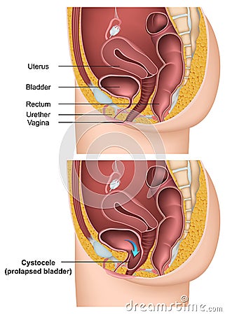 Bladder Cystocele with description medical illustration Cartoon Illustration