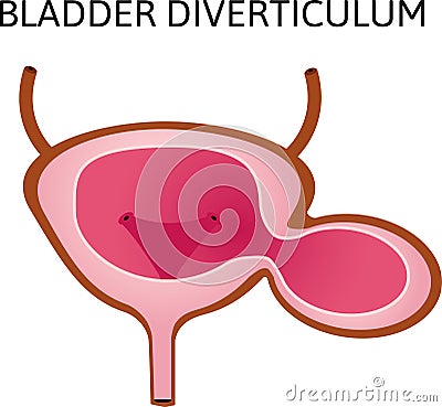 A bladder diverticulum is a pouch in the bladder wall. Two similar cavities. outpouching of a hollow structure in the Vector Illustration