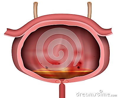 Bladder inflammation 3d vector illustration unlabeled on white background Vector Illustration