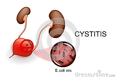 Bladder and kidneys. cystitis Vector Illustration