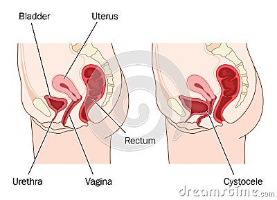 Bladder prolapse Vector Illustration