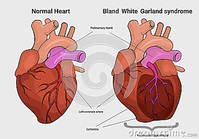 Bland White Garland syndrome versus normal heart anatomy Vector Illustration