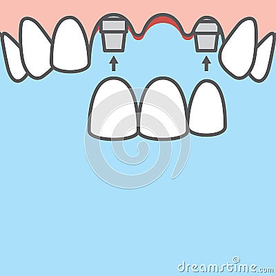 Blank banner Bridges teeth upper implant illustration vector on blue background. Dental concept Vector Illustration