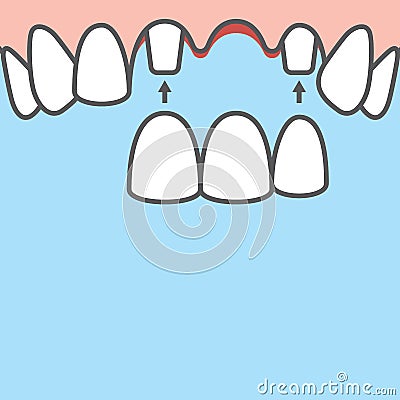 Blank banner Bridges teeth upper original root illustration vector on blue background. Dental concept Vector Illustration