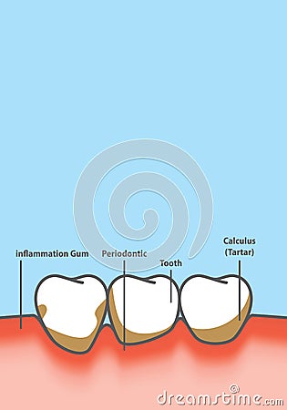 Blank banner Human gum inflammation frame cartoon style for info or book illustration vector on blue background. Dental concept Vector Illustration