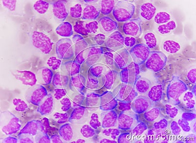 Blast cells in Leukemia Stock Photo