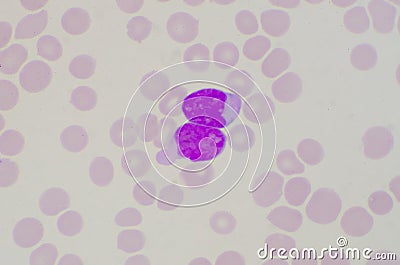 Blast cells on red blood cells background Stock Photo