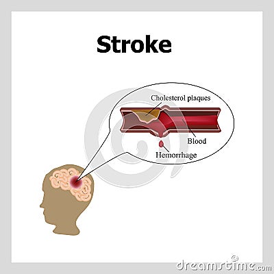 Bleeding in the brain. Insult. Stroke, atherosclerosis. Cholesterol plaques. Infographics. Vector illustration Vector Illustration
