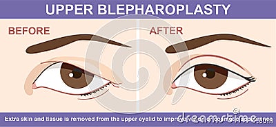 Blepharoplasty of eyelid , before and after. Vector illustration with double eyelid surgery. Infographics with icons of Vector Illustration