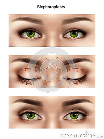 Blepharoplasty Suture Stitches Composition Vector Illustration