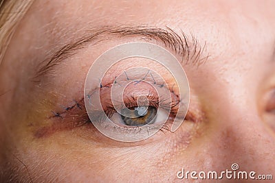 Blepharoplasty of the upper eyelid. Stock Photo