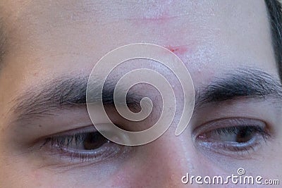 Blisters caused by shingles on left face skin After the onset of headaches and eye 11th days. Stock Photo