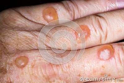 Blisters from cryotherapy treatment for solar keratosis Stock Photo