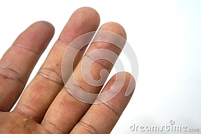 Blisters on the tip of the ring finger and little finger Stock Photo