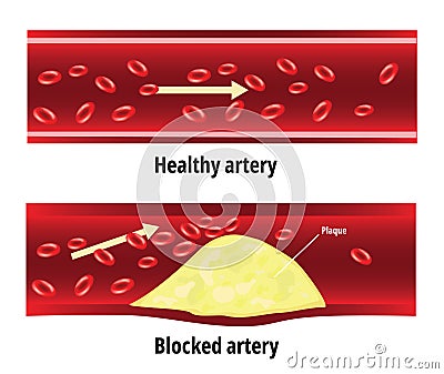 Blocked artery, fat stuck in the blood artery, Vector Illustration