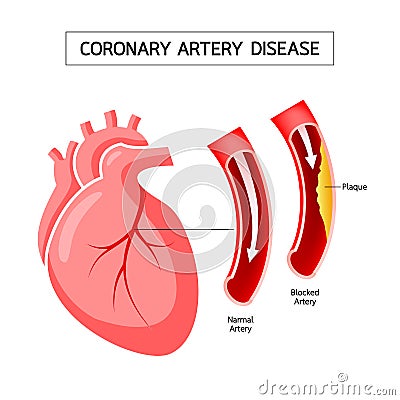 Human heart with Coronary Artery Disease info graphic. Vector Illustration