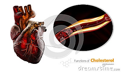 Blocked blood vessel, artery with cholesterol buildup, 3d Illustration isolated white Stock Photo