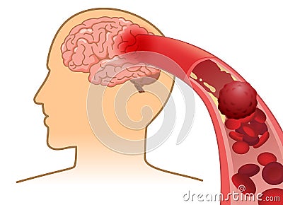 Blood cell can`t flow into human brain because clogged arteries by blood clot. Vector Illustration