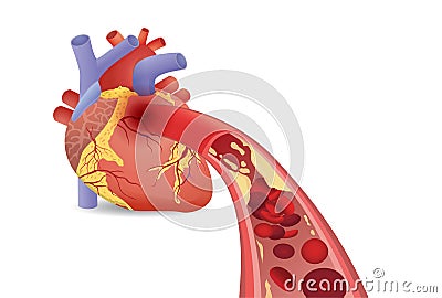 Blood cell can`t flow into human heart because clogged arteries by fatty. Vector Illustration