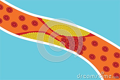 Blood circulation vessels are blocked by extra body fat. Red blood cells are blocked by yellow fat inside an artery. Human anatomy Vector Illustration