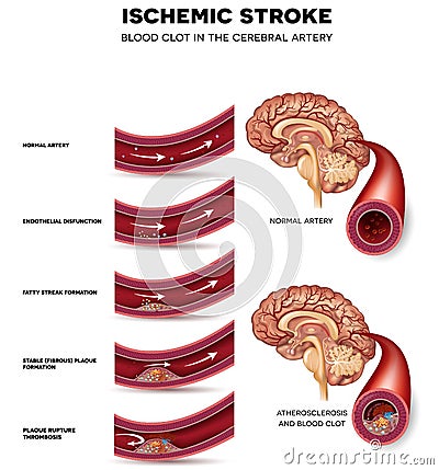 Blood clot formation in the cerebral artery Vector Illustration