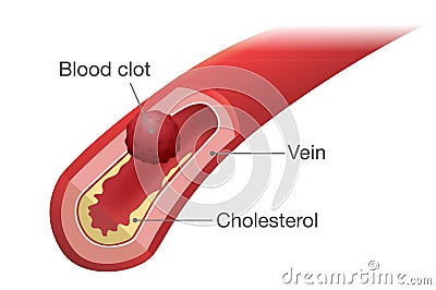 Blood clot occurs in a vein. Vector Illustration