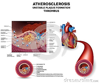 Blood clot Vector Illustration