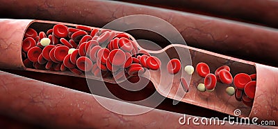 Blood clot Stock Photo