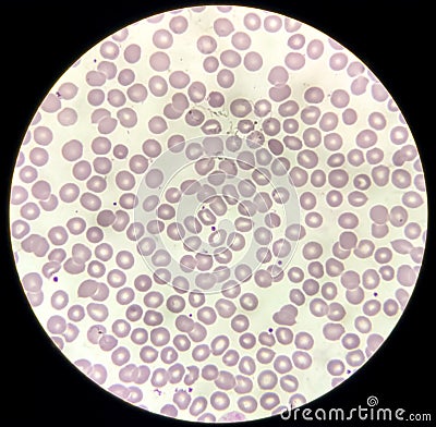 Blood film microscopic show decrease platelets leucocyte (WBC). Stock Photo