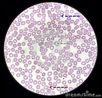 Blood film microscopic show decrease platelets leucocyte (WBC). Stock Photo