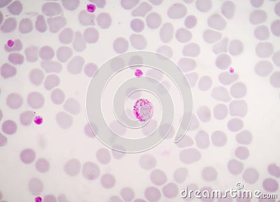 Blood films for Malaria parasite. Stock Photo