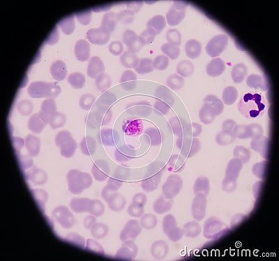 Blood films for Malaria parasite.show malaria pigment. Stock Photo