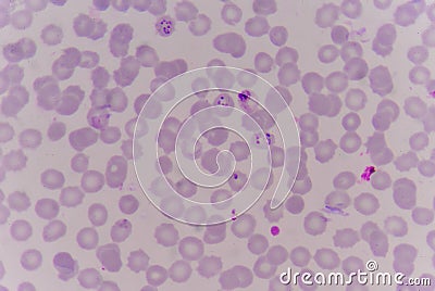 Blood films for Malaria parasite. Stock Photo