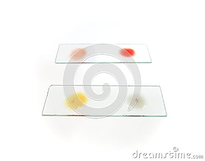 Blood group tasting of an O positive doner, with blood drop after mixing with blood grouping reagent. Stock Photo