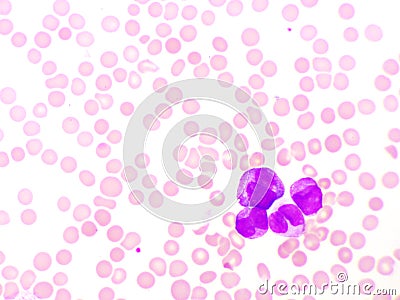 Blood picture of acute promyelocytic leukemia or APL Stock Photo