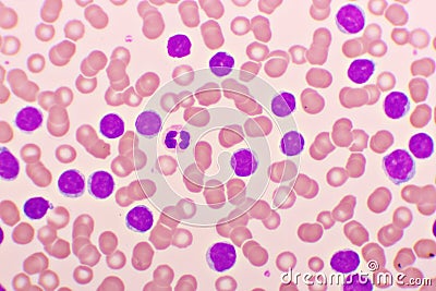 Blood picture of chronic lymphocytic leukemia or CLL Stock Photo