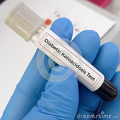 Blood sample for diabetic ketoacidosis (DKA) test. A complication of diabetes that can lead to a coma or even death. Stock Photo