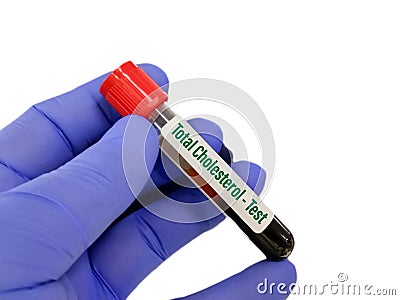 Blood sample for Total cholesterol test Stock Photo
