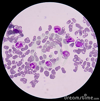 Blood smear form sepsis. Stock Photo