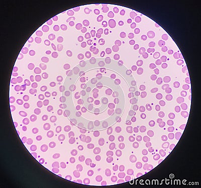 Blood smear show platelet increase Stock Photo