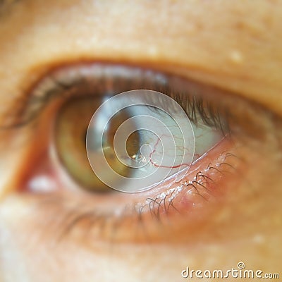 Blood vessel on the eyeball. Selective focus on blood vessels. Intraocular pressure. Bloodshot eyes. Close-up macro photography. Stock Photo