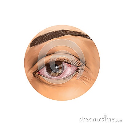 Bloodshot eye Stock Photo