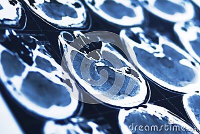 Blurred closeup of brain granular structure, computerized tomography Stock Photo