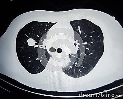 Blurry with noise of a Ct scan film of lung cancer in black and white close up. Stock Photo