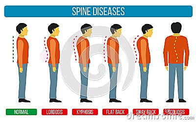 Body posture defect. Vector infographics of spine diseases. Scoliosis and lordosis medical diagrams Vector Illustration