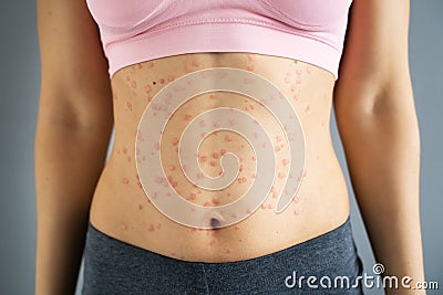 Body Skin With Psoriasis Autoimmune Disease Stock Photo