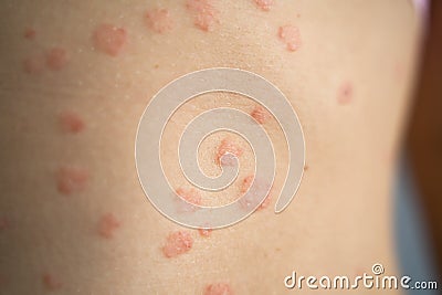 Body Skin With Psoriasis Autoimmune Disease Stock Photo
