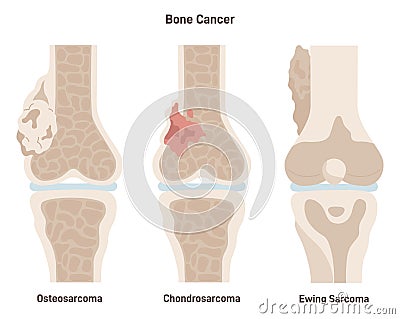 Bone cancer types set. Ewing's sarcoma, osteosarcoma and chondrosarcoma. Vector Illustration